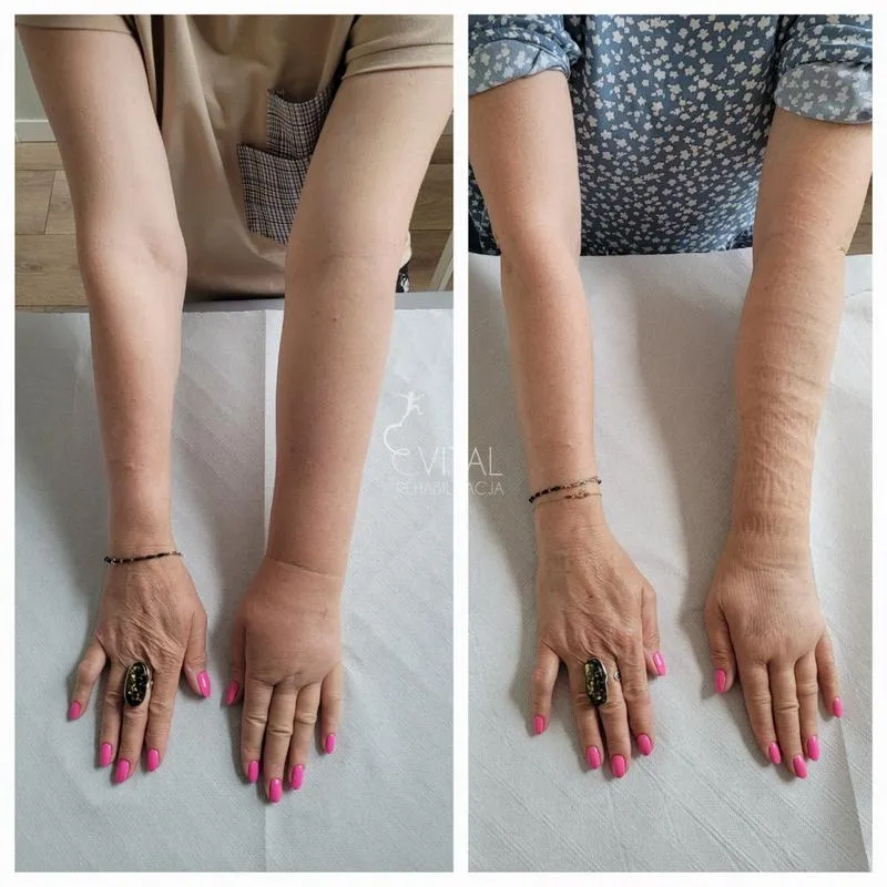 Obrzęk limfatyczny po mastektomii